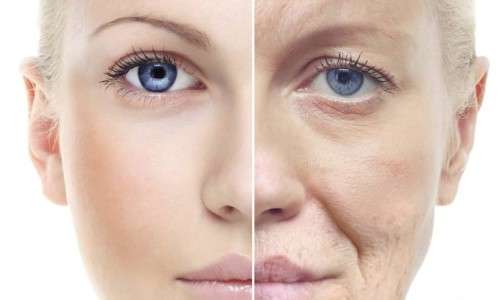 Wrinkle Fillers / Fat Grafting Treatment under the best cosmetics surgery in Pakistan