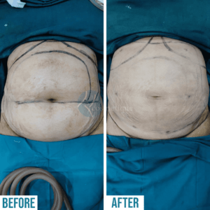 Tumescent Liposuction Surgery under best cosmetic surgery in Pakistan.