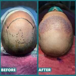 Hair Transplant Surgery best cosmetic surgery in Lahore, Hair Transplant Surgery best cosmetic surgery in Pakistan