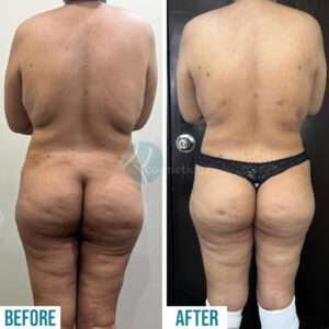 Liposuction Treatment under the best cosmetic surgery in pakistan