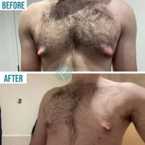 Gynaecomastia Surgery by best cosmetic surgery in pakistan ,
